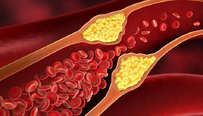 Ways to Reduce Cholesterol