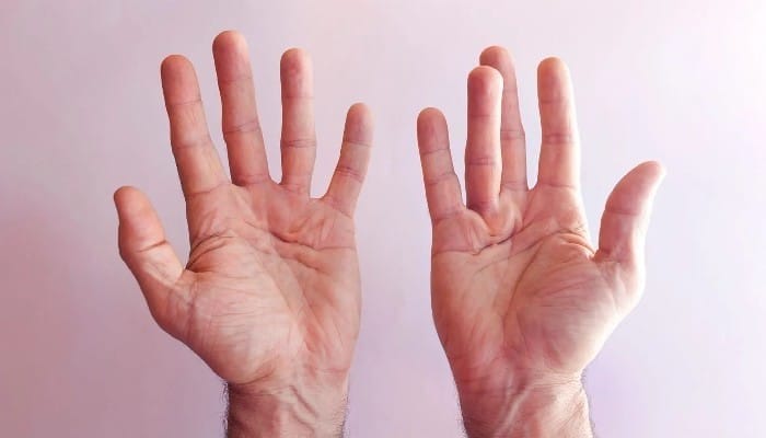 Symptoms of Cholesterol